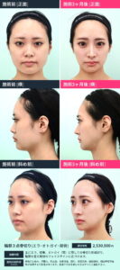 施術前後比較 輪郭3点切り1