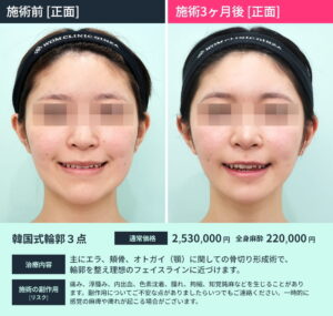 施術前後比較 輪郭3点切り2