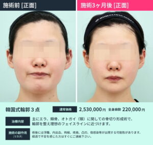 施術前後比較 輪郭3点切り3