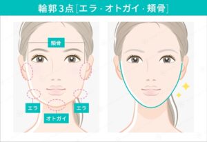 輪郭3点の施術位置と術後の輪郭例