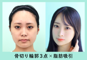 輪郭3点と脂肪吸引のビフォーアフター