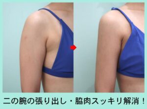 二の腕＋肩＋付け根＋副乳の脂肪吸引のビフォーアフター