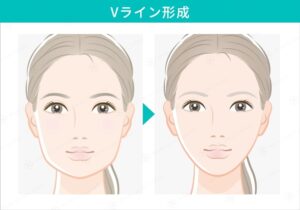 Vライン形成の施術前と施術後の女性の顔
