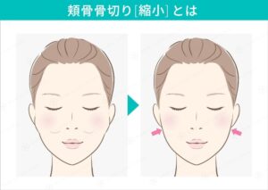 頬骨縮小の施術前後を比較した女性の顔