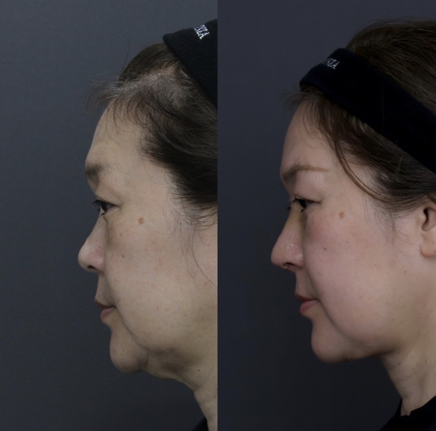 『【顎下のたるみ改善】ペリカン手術で根本から引き締める 脂肪吸引だけでは改善できない“本当のたるみ”とは』の画像