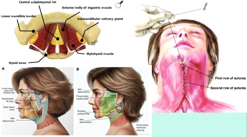 『【顎下のたるみ改善】ペリカン手術で根本から引き締める 脂肪吸引だけでは改善できない“本当のたるみ”とは』の画像