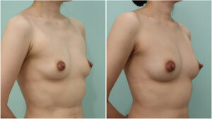 『【実は豊胸が向いている！？】授乳後の胸は脂肪豊胸でここまで大きくできます。』の画像