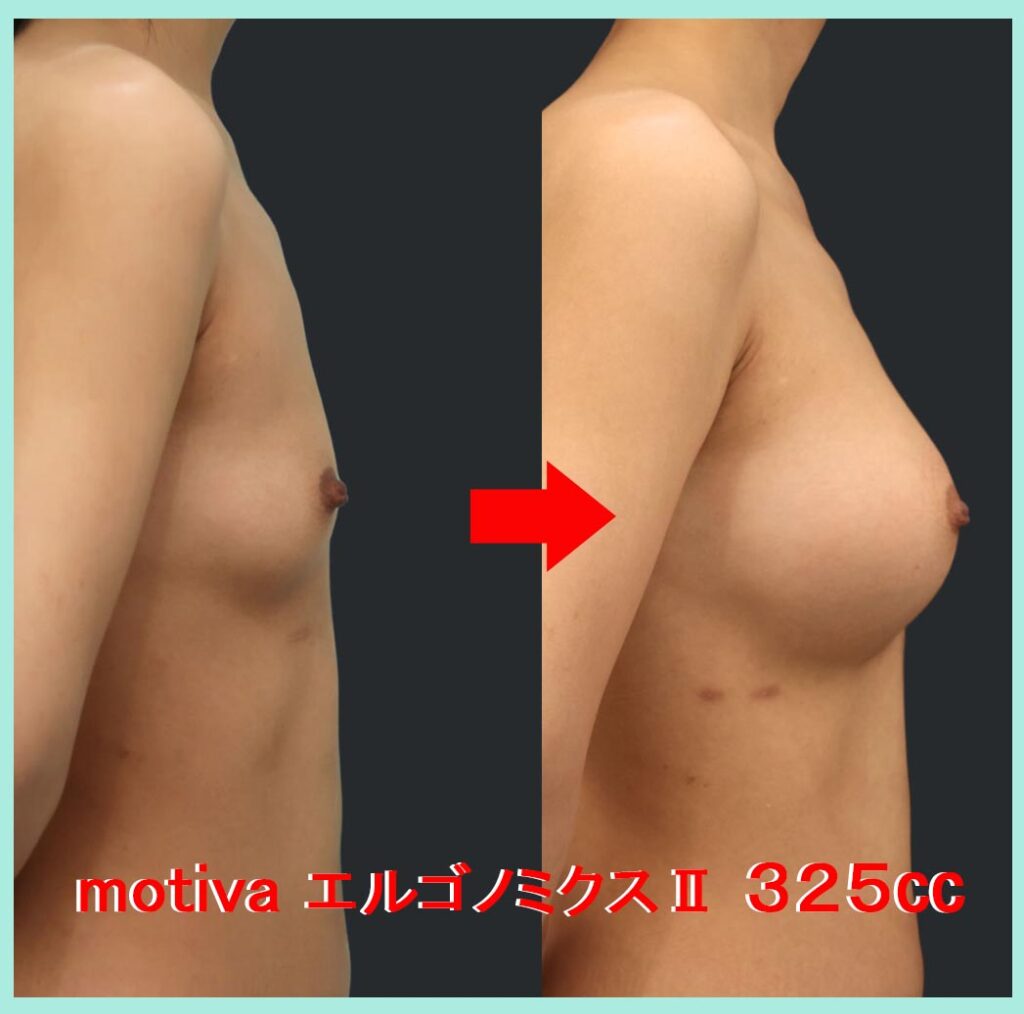 『確実な「シリコンプロテーゼ豊胸」、しっかり大きくしたい人はデュアルプレーン法で美しいバストへ』の画像