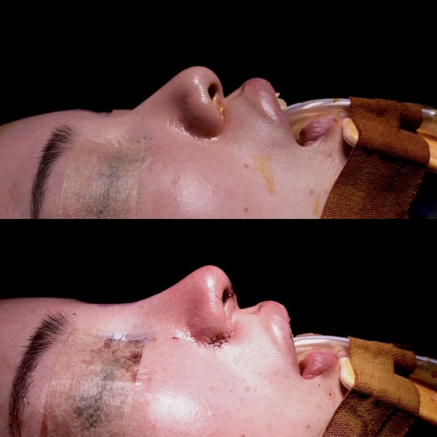 『【初回鼻整形】鼻を細く・高くするには骨から整える 骨切り幅寄せ×自家組織でつくる立体的で洗練された鼻』の画像