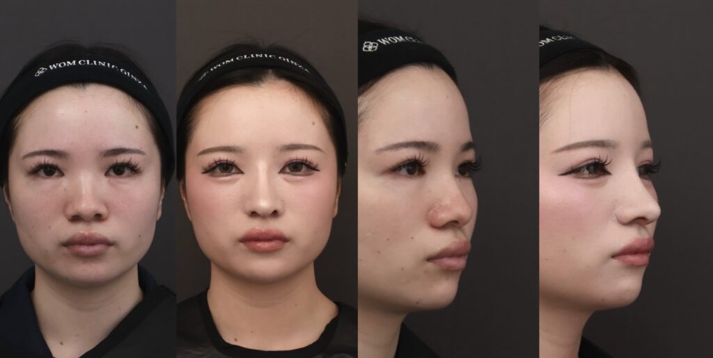 『【初回鼻整形】鼻を細く・高くするには骨から整える 骨切り幅寄せ×自家組織でつくる立体的で洗練された鼻』の画像