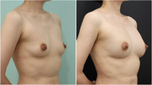 『【実は豊胸が向いている！？】授乳後の胸は脂肪豊胸でここまで大きくできます。』の画像