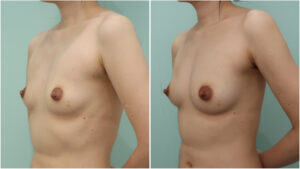 『【実は豊胸が向いている！？】授乳後の胸は脂肪豊胸でここまで大きくできます。』の画像