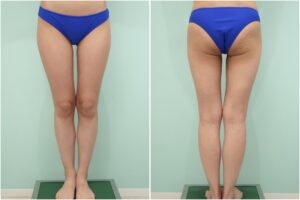 『美脚の鍵は、股下の隙間にある。術後3ヶ月までのリアルな経過をお見せします。』の画像