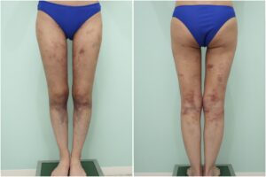 『美脚の鍵は、股下の隙間にある。術後3ヶ月までのリアルな経過をお見せします。』の画像