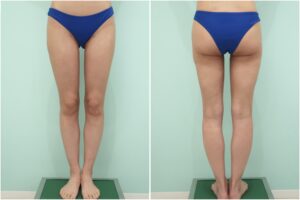 『美脚の鍵は、股下の隙間にある。術後3ヶ月までのリアルな経過をお見せします。』の画像