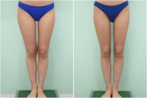 『美脚の鍵は、股下の隙間にある。術後3ヶ月までのリアルな経過をお見せします。』の画像