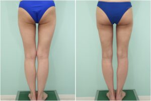 『美脚の鍵は、股下の隙間にある。術後3ヶ月までのリアルな経過をお見せします。』の画像