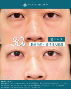 『裏ハムラ手術のライブサージャリーと症例解説｜自然な仕上がりのポイント』の画像