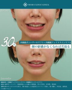 『内視鏡ポニーテールリフトで頬の位置を自然に上げる方法|中顔面リフトの新常識』の画像