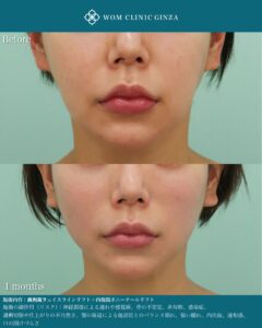 『内視鏡ポニーテールリフトで頬の位置を自然に上げる方法|中顔面リフトの新常識』の画像