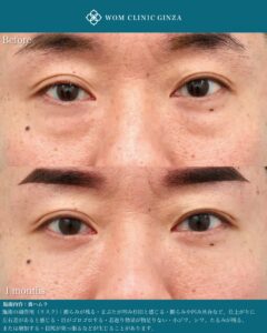 『男性の裏ハムラ手術|自然なクマ治療と症例解説|40代男性の若返り』の画像