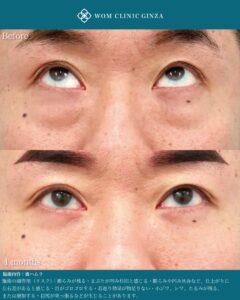 『男性の裏ハムラ手術|自然なクマ治療と症例解説|40代男性の若返り』の画像