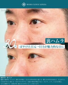 『男性の裏ハムラ手術|自然なクマ治療と症例解説|40代男性の若返り』の画像