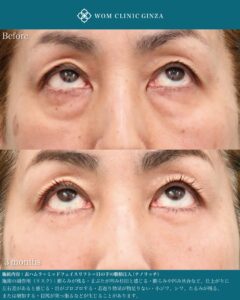 『表ハムラ手術の微調整とは｜年齢別に変わる涙袋と自然な若返りのポイント』の画像