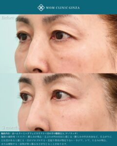 『表ハムラ手術の微調整とは｜年齢別に変わる涙袋と自然な若返りのポイント』の画像