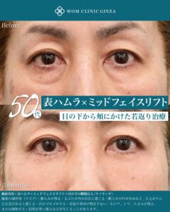 『表ハムラ手術の微調整とは｜年齢別に変わる涙袋と自然な若返りのポイント』の画像