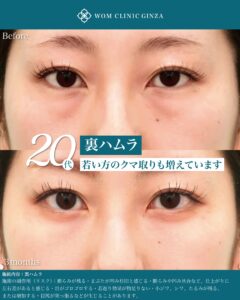 『裏ハムラ手術を極める｜自然な仕上がりを実現する精度と解剖学的アプローチ』の画像