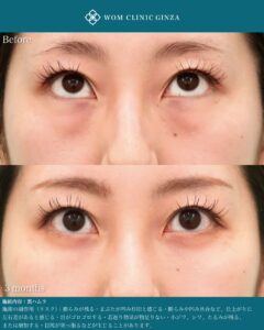 『裏ハムラ手術を極める｜自然な仕上がりを実現する精度と解剖学的アプローチ』の画像