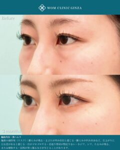 『裏ハムラ手術を極める｜自然な仕上がりを実現する精度と解剖学的アプローチ』の画像