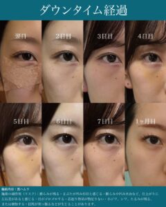 『裏ハムラ手術を極める｜自然な仕上がりを実現する精度と解剖学的アプローチ』の画像