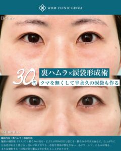 『涙袋形成で目を大きく見せる方法｜裏ハムラ併用による自然な仕上がり』の画像
