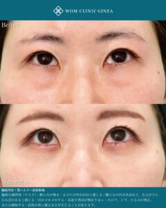 『涙袋形成で目を大きく見せる方法｜裏ハムラ併用による自然な仕上がり』の画像