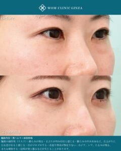 『涙袋形成で目を大きく見せる方法｜裏ハムラ併用による自然な仕上がり』の画像