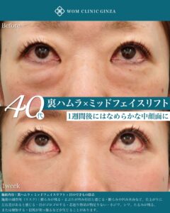 『ゴルゴラインを裏ハムラで改善する方法｜中顔面リフトとの組み合わせと症例解説』の画像
