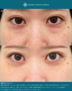 『裏ハムラで涙袋を自然に整える方法|出しすぎないデザインと症例解説』の画像
