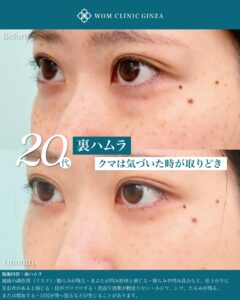 『裏ハムラで涙袋を自然に整える方法|出しすぎないデザインと症例解説』の画像