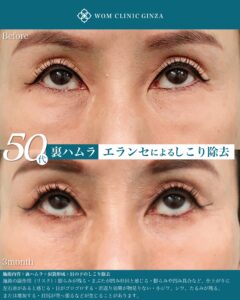 『目の下のしこり除去は裏側から｜結膜アプローチの安全性と症例解説』の画像