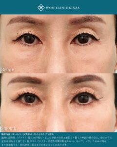 『目の下のしこり除去は裏側から｜結膜アプローチの安全性と症例解説』の画像