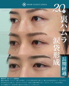 『涙袋形成の6ヶ月後の変化とは｜長期的に自然な仕上がりを保つ方法』の画像