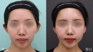 『【劇的変化】脂肪吸引×脂肪注入でここまで変わる・輪郭トータルアプローチ』の画像