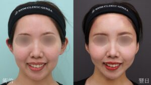 『【劇的変化】脂肪吸引×脂肪注入でここまで変わる・輪郭トータルアプローチ』の画像