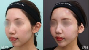『【劇的変化】脂肪吸引×脂肪注入でここまで変わる・輪郭トータルアプローチ』の画像
