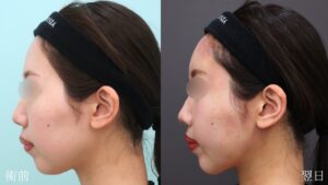 『【劇的変化】脂肪吸引×脂肪注入でここまで変わる・輪郭トータルアプローチ』の画像