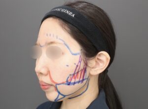 『【劇的変化】脂肪吸引×脂肪注入でここまで変わる・輪郭トータルアプローチ』の画像