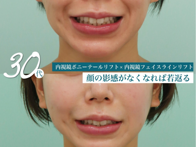 ポニーテールリフト