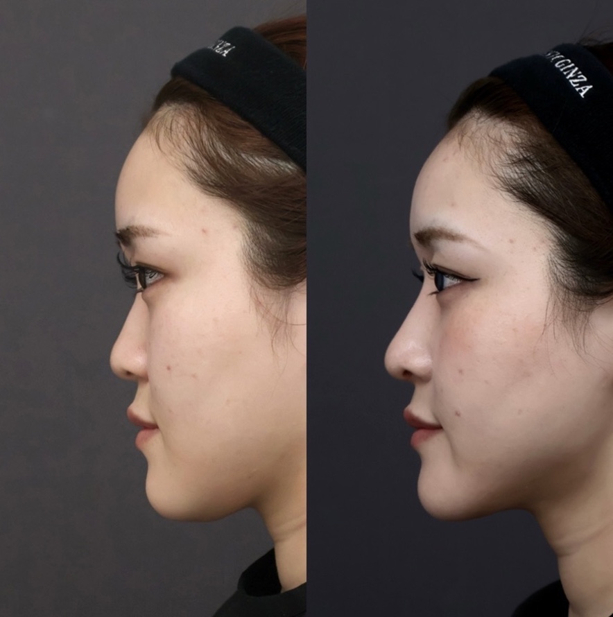 『【初回鼻整形】鼻を高くするだけでは足りない 中顔面の立体感で“顔全体のバランス”を整える鼻整形』の画像